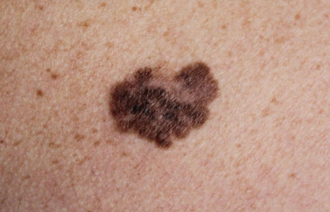 Melanoma2