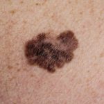 Melanoma2